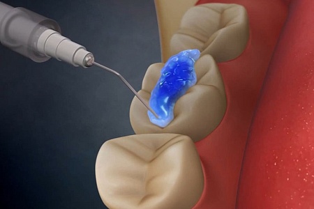 Скидка 50% на профилактику кариеса у детей